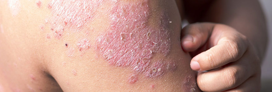 Soigner le psoriasis